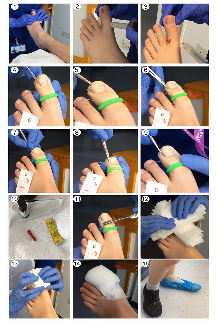 Ingrown Toe Nail Surgery Case Study